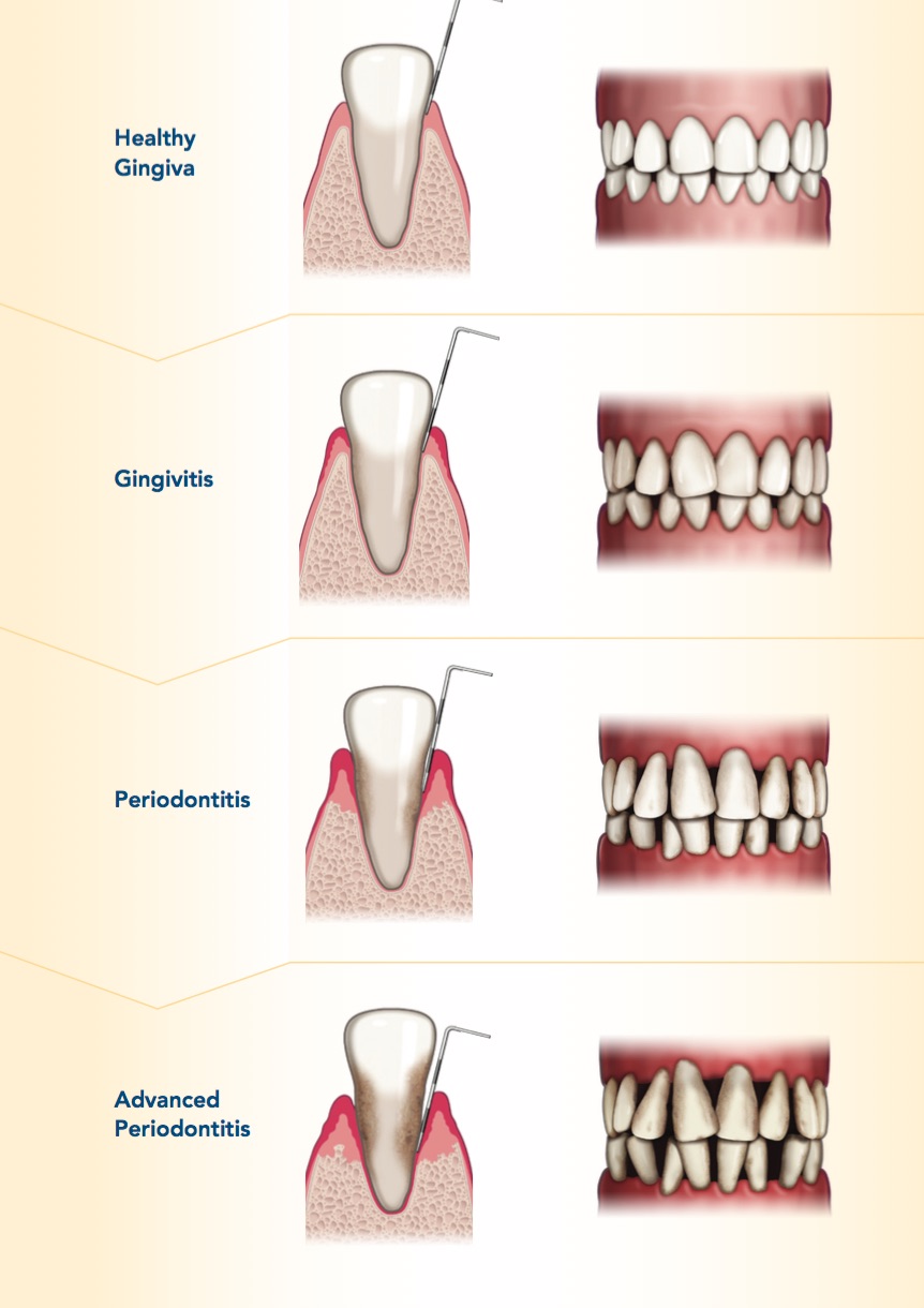 The four stages of gum disease: healthy gingiva, gingivitis, periodontitis, and advanced periodontitis