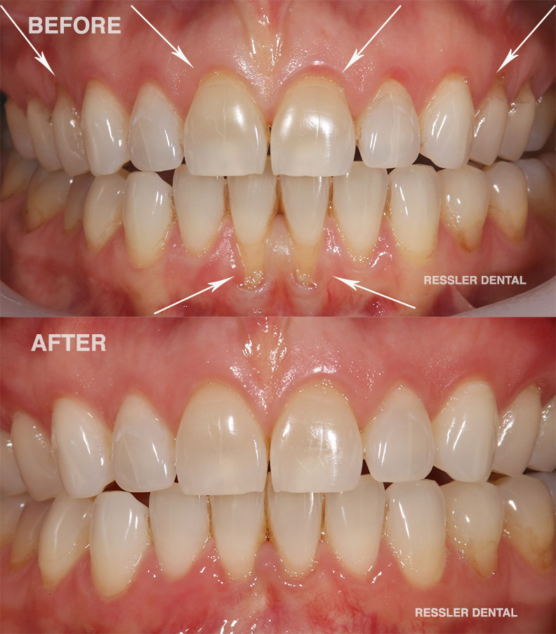 Chao Pinhole gum procedure before and after photos