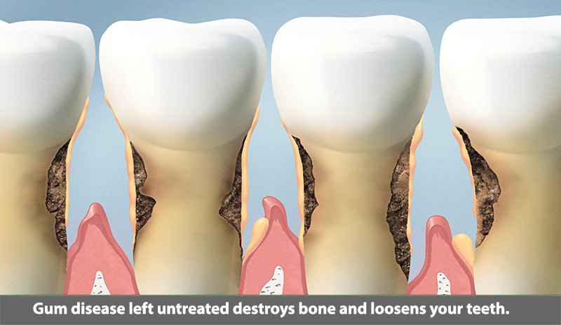 Untreated gum disease destroys the bone that holds your teeth in place