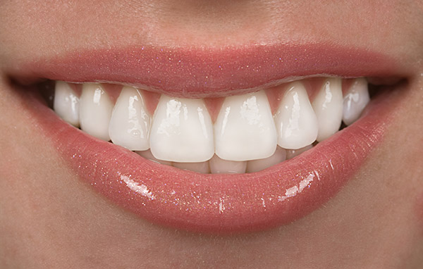 Radiant, natural-looking smile created by cosmetic dentist Dr. Ressler in Delray Beach