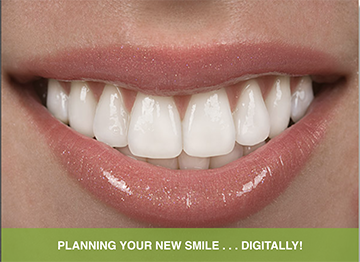 Veneers and porcelain crowns by a cosmetic dentist serving Boynton Beach, Delray Beach, and Boca Raton