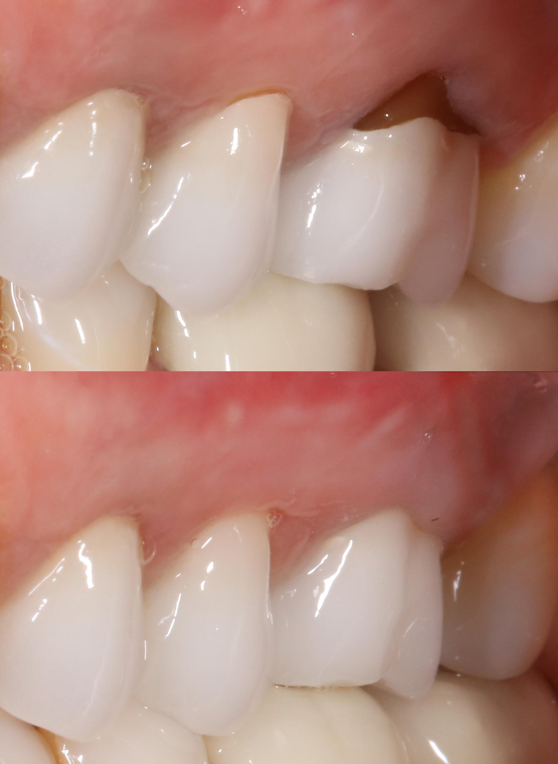 Julia's gum recession before and after Chao Pinhole treatment, 6 months post-op