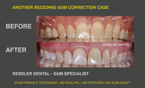 How the Chao Pinhole technique repairs receding gums without grafting