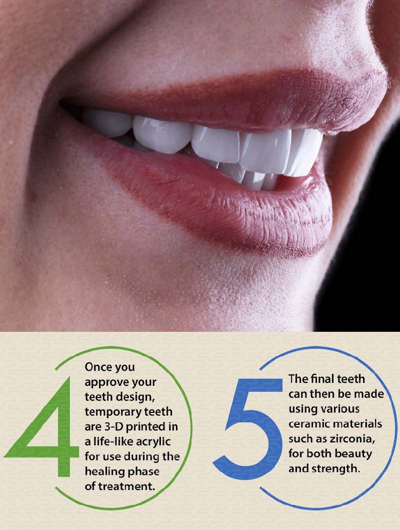 Digital smile designer steps 4 and 5: 3-D printed temporaries and final ceramic teeth