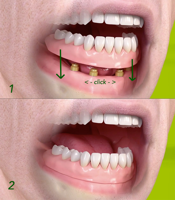 Click-on removable implant denture secured by dental implants