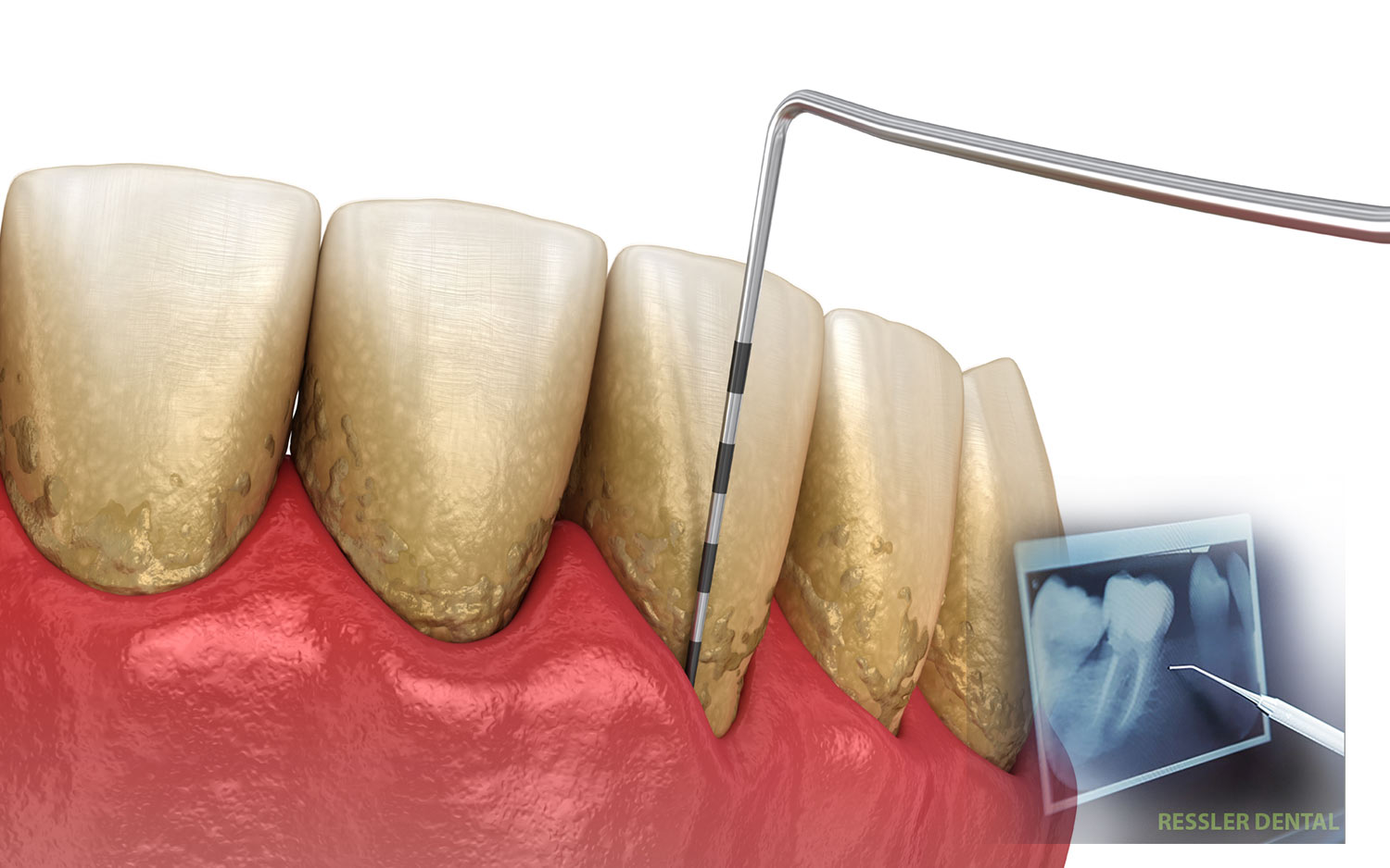 Gum disease diagnosis with dental x-rays and a periodontal probe examination