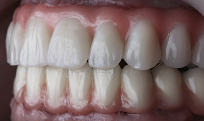 All-on-4 full arch dental implant teeth, permanently attached to four implants