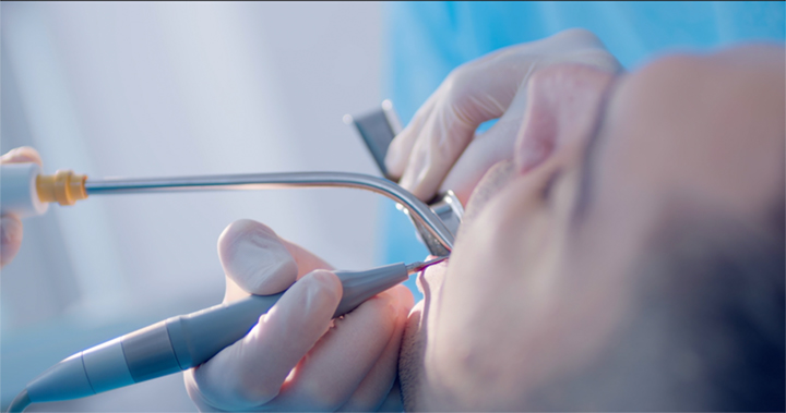 Step one of laser gum treatment: deep cleaning above the gum line