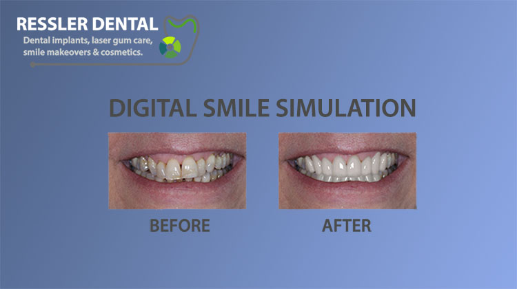 Digital smile simulation at Ressler Dental showing a patient's before-and-after smile makeover preview