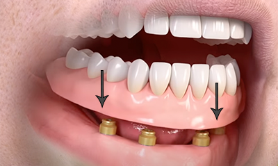 Snap-in implant denture secured with locator attachments on dental implants