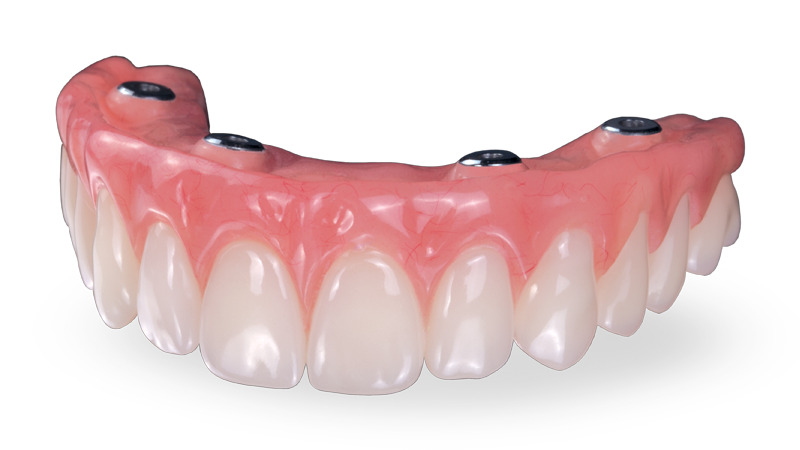 Acrylic full arch All-on-4 implant teeth