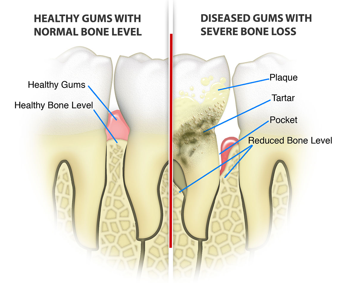 Healthy gums compared with gum disease, bone loss, and deep periodontal pockets