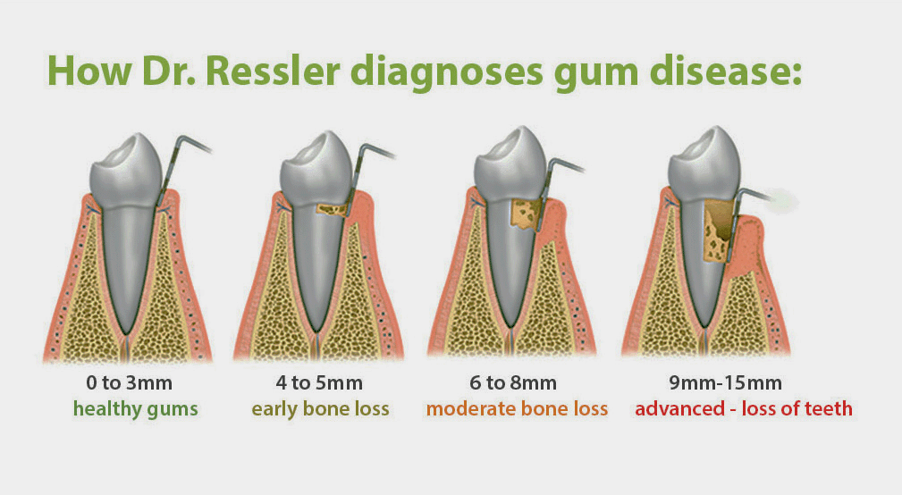 Step two of laser gum treatment: laser cleans gum pockets below the gum line